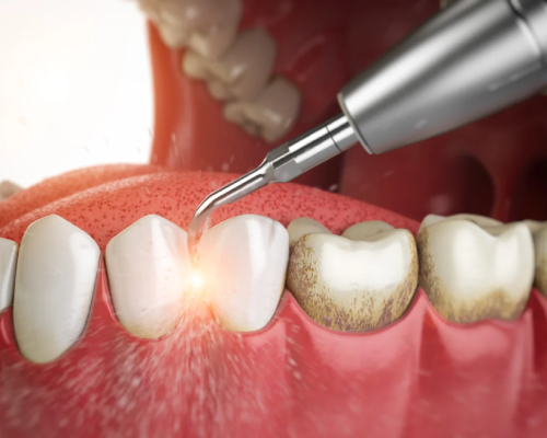 Teeth Cleaning & Whitening